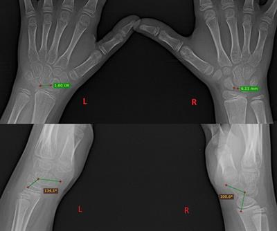 Non-traumatic scapholunate dissociation in a 10-year-old female: A case report